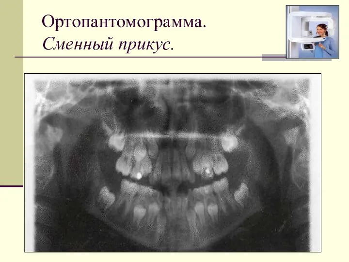 Ортопантомограмма. Сменный прикус.