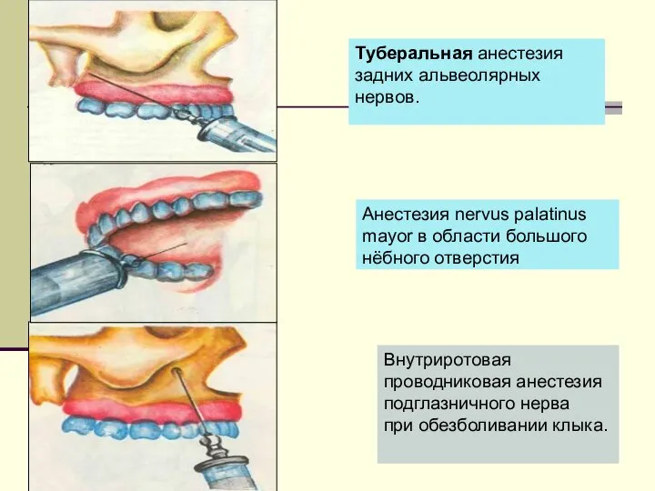 Внутриротовая проводниковая анестезия подглазничного нерва при обезболивании клыка. Туберальная анестезия задних