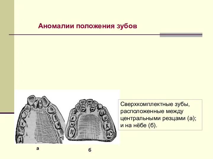 Аномалии положения зубов Сверхкомплектные зубы, расположенные между центральными резцами (а); и на нёбе (б). а б