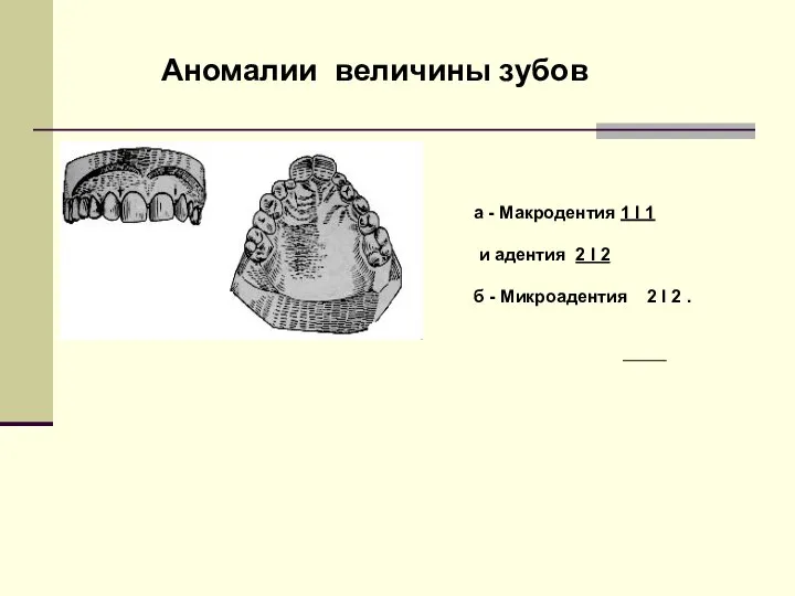 Аномалии величины зубов а - Макродентия 1 І 1 и адентия