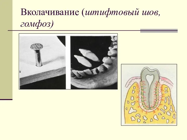 Вколачивание (штифтовый шов, гомфоз)