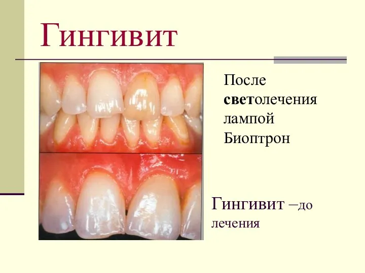 Гингивит –до лечения После светолечения лампой Биоптрон Гингивит