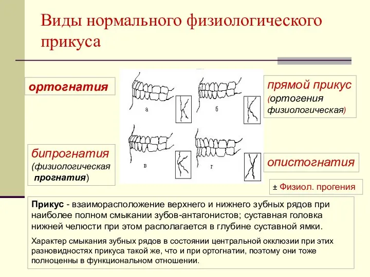 ортогнатия Виды нормального физиологического прикуса бипрогнатия (физиологическая прогнатия) опистогнатия прямой прикус