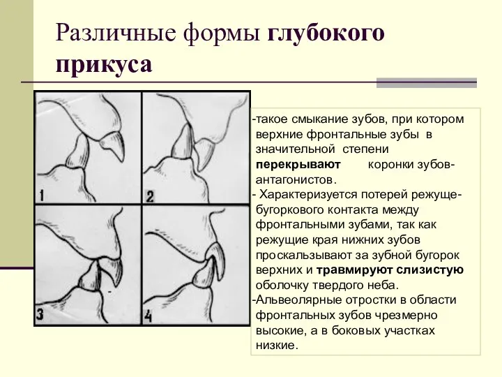 Различные формы глубокого прикуса такое смыкание зубов, при котором верхние фронтальные