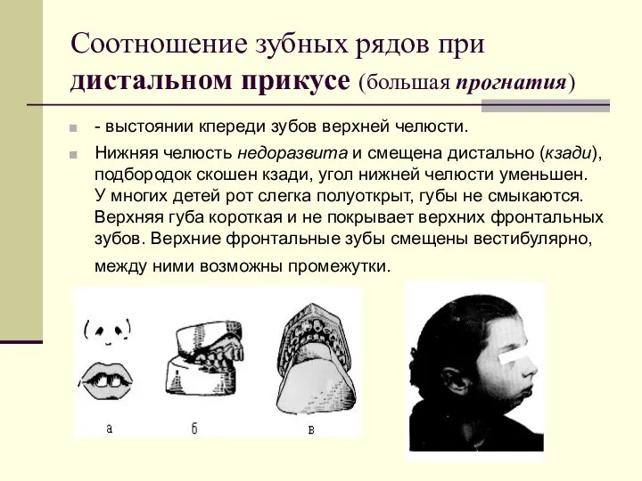 Соотношение зубных рядов при дистальном прикусе (большая прогнатия) - выстоянии кпереди