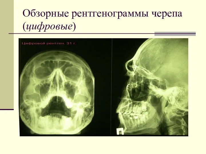 Обзорные рентгенограммы черепа (цифровые)