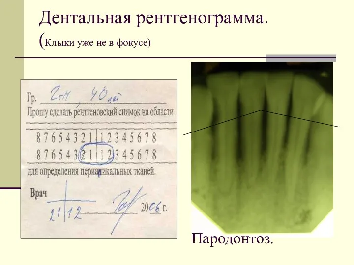 Дентальная рентгенограмма. (Клыки уже не в фокусе) Пародонтоз.