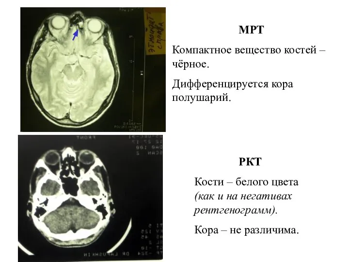 МРТ Компактное вещество костей – чёрное. Дифференцируется кора полушарий. РКТ Кости