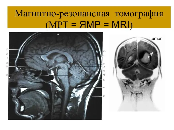 Магнитно-резонансная томография (МРТ = ЯМР = MRI) tumor