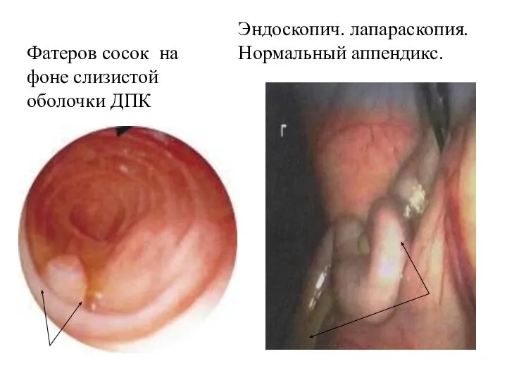 Эндоскопич. лапараскопия. Нормальный аппендикс. Фатеров сосок на фоне слизистой оболочки ДПК