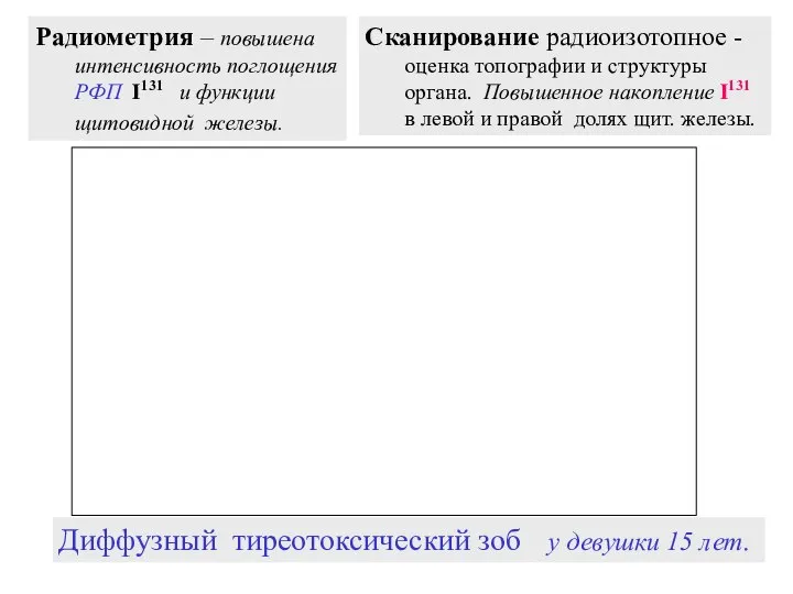 Радиометрия – повышена интенсивность поглощения РФП I131 и функции щитовидной железы.