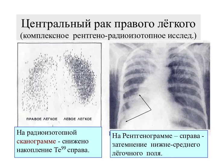 Центральный рак правого лёгкого (комплексное рентгено-радиоизотопное исслед.) На радиоизотопной сканограмме -