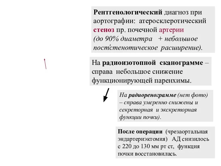 Рентгенологический диагноз при аортографии: атеросклеротический стеноз пр. почечной артерии (до 90%