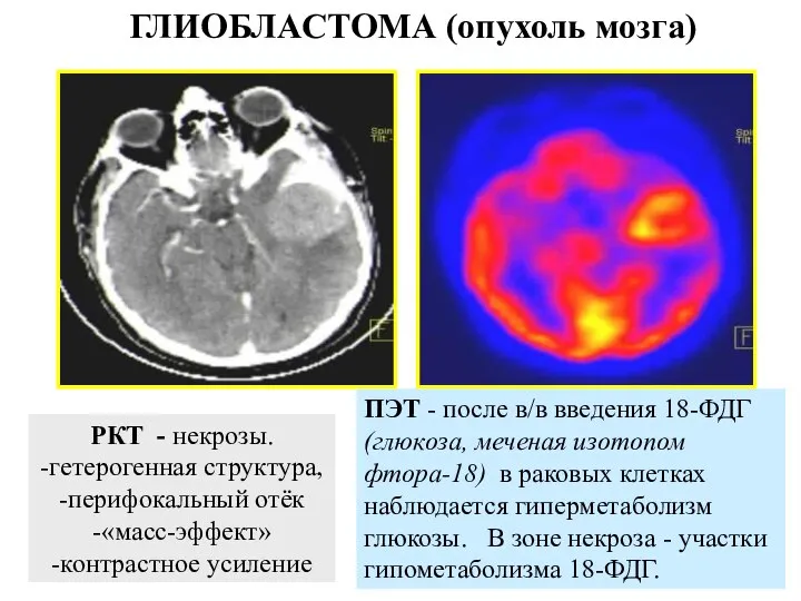 ГЛИОБЛАСТОМА (опухоль мозга) РКТ - некрозы. -гетерогенная структура, -перифокальный отёк -«масс-эффект»