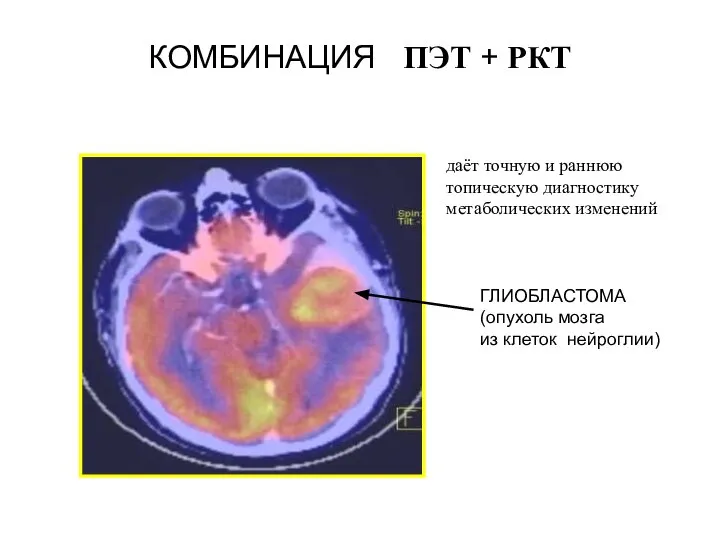 ГЛИОБЛАСТОМА (опухоль мозга из клеток нейроглии) КОМБИНАЦИЯ ПЭТ + РКТ даёт