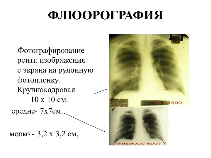 ФЛЮОРОГРАФИЯ Фотографирование рентг. изображения с экрана на рулонную фотопленку. Крупнокадровая 10