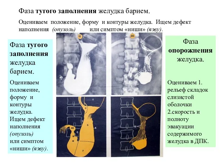 Фаза тугого заполнения желудка барием. Оцениваем положение, форму и контуры желудка.