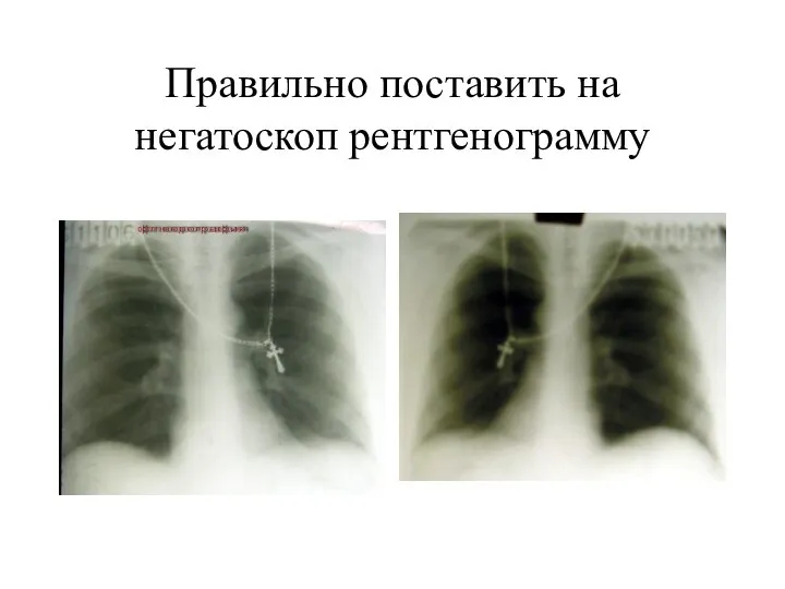 Правильно поставить на негатоскоп рентгенограмму