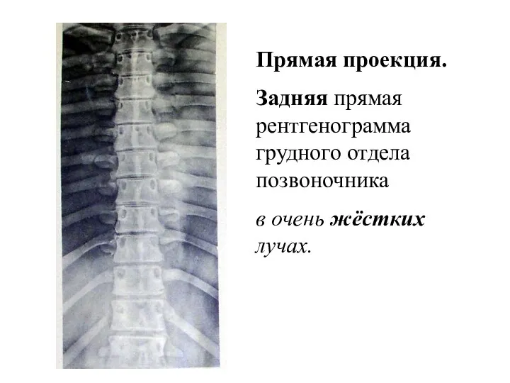 Прямая проекция. Задняя прямая рентгенограмма грудного отдела позвоночника в очень жёстких лучах.