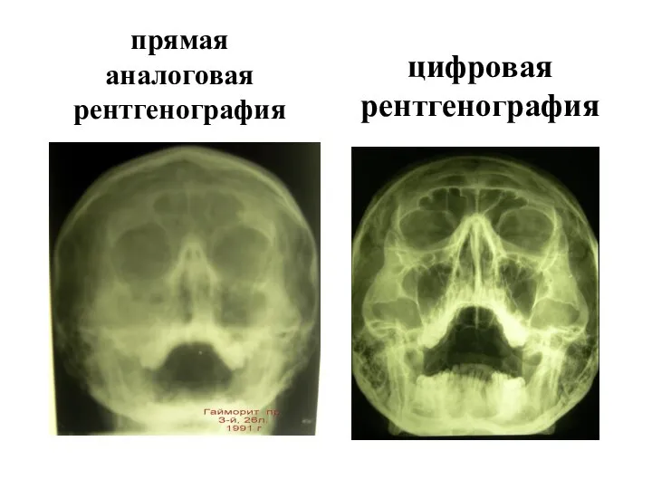 прямая аналоговая рентгенография цифровая рентгенография