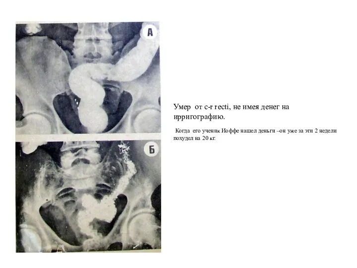 Умер от с-r recti, не имея денег на ирригографию. Когда его