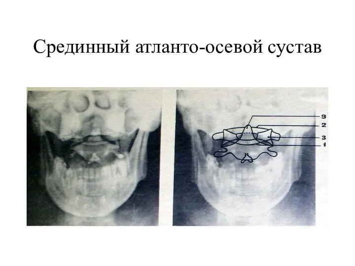 Срединный атланто-осевой сустав