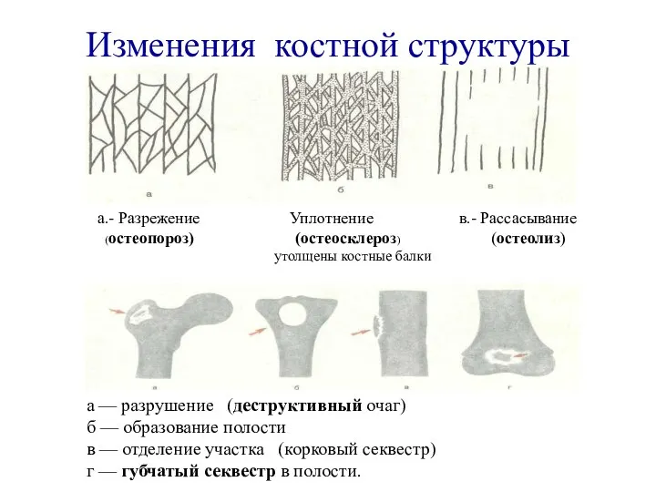 Изменения костной структуры а.- Разрежение Уплотнение в.- Рассасывание (остеопороз) (остеосклероз) (остеолиз)