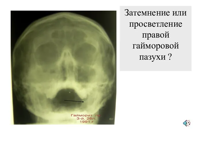 Затемнение или просветление правой гайморовой пазухи ?