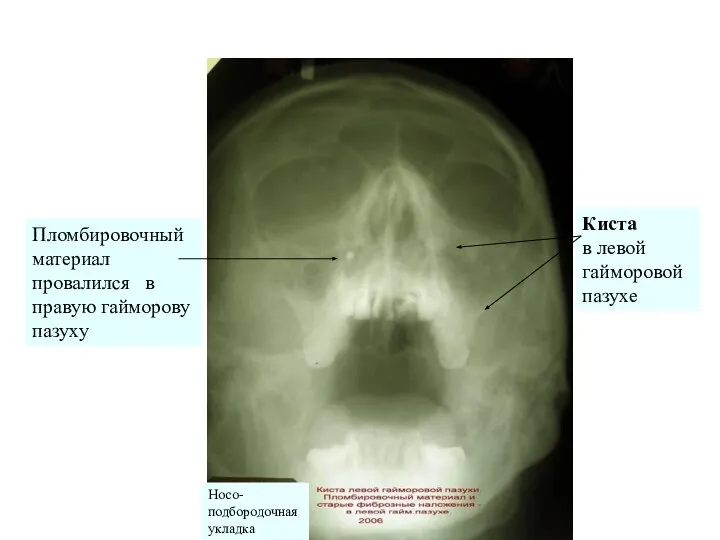 Пломбировочный материал провалился в правую гайморову пазуху Киста в левой гайморовой пазухе Носо- подбородочная укладка