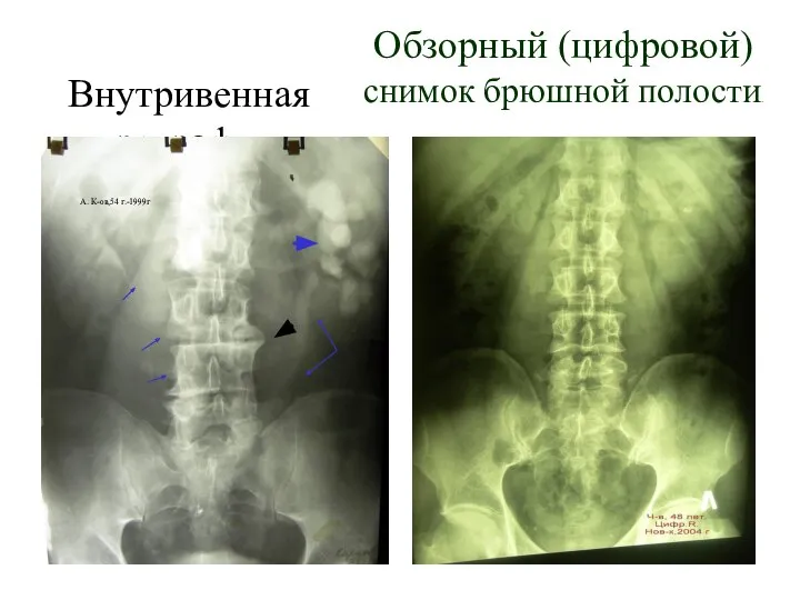 Внутривенная урография. А. К-ов,54 г.-1999г Обзорный (цифровой) снимок брюшной полости.