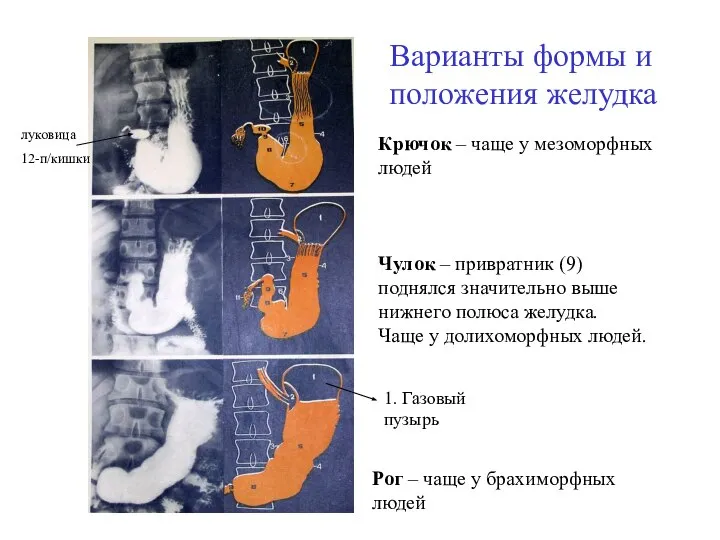 Варианты формы и положения желудка Рог – чаще у брахиморфных людей