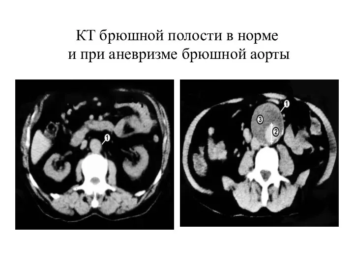 КТ брюшной полости в норме и при аневризме брюшной аорты