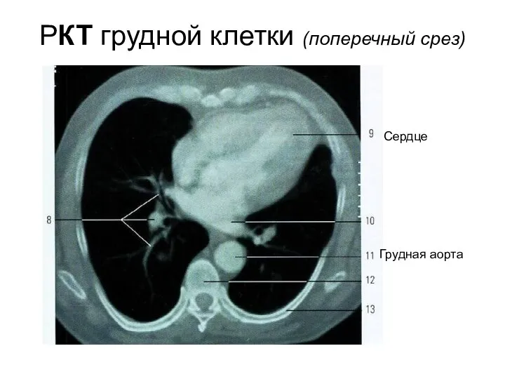 РКТ грудной клетки (поперечный срез) Грудная аорта Сердце