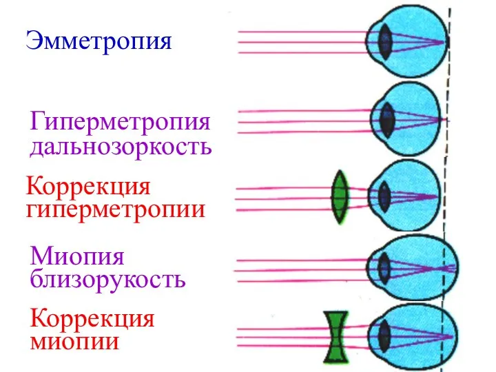 Эмметропия Гиперметропия дальнозоркость Коррекция гиперметропии Миопия близорукость Коррекция миопии
