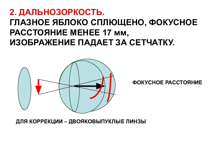 2. ДАЛЬНОЗОРКОСТЬ. ГЛАЗНОЕ ЯБЛОКО СПЛЮЩЕНО, ФОКУСНОЕ РАССТОЯНИЕ МЕНЕЕ 17 мм, ИЗОБРАЖЕНИЕ