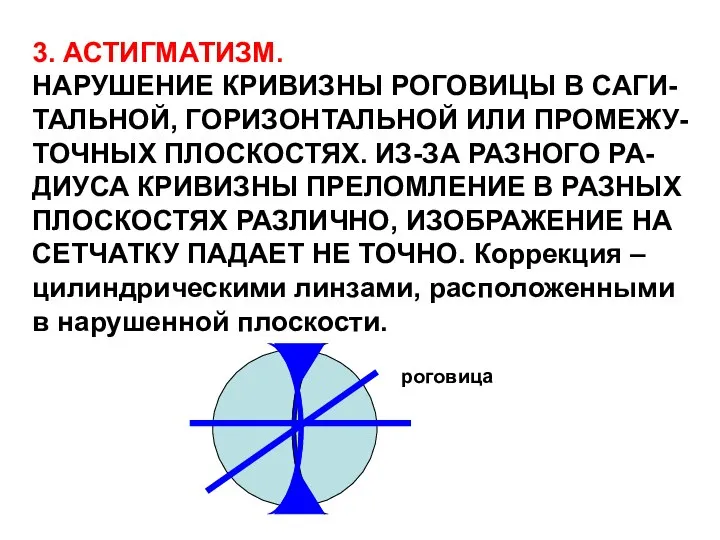 3. АСТИГМАТИЗМ. НАРУШЕНИЕ КРИВИЗНЫ РОГОВИЦЫ В САГИ- ТАЛЬНОЙ, ГОРИЗОНТАЛЬНОЙ ИЛИ ПРОМЕЖУ-