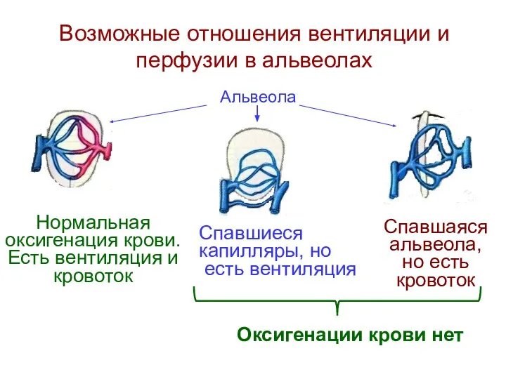 Возможные отношения вентиляции и перфузии в альвеолах Альвеола Нормальная оксигенация крови.