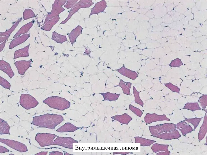 Внутримышечная липома