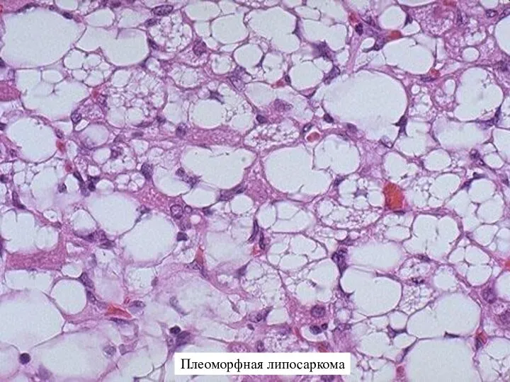 Плеоморфная липосаркома