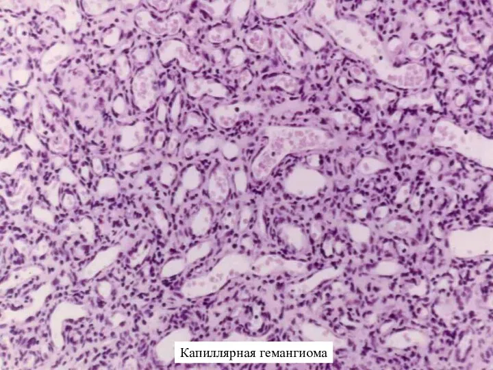 Капиллярная гемангиома