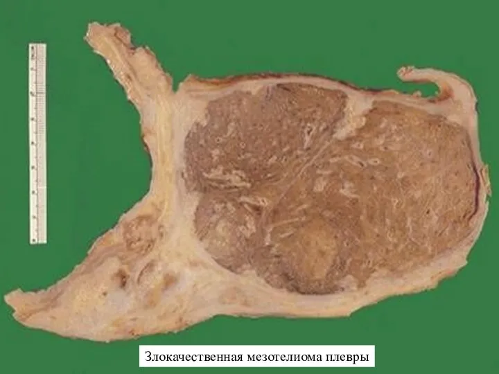 Злокачественная мезотелиома плевры