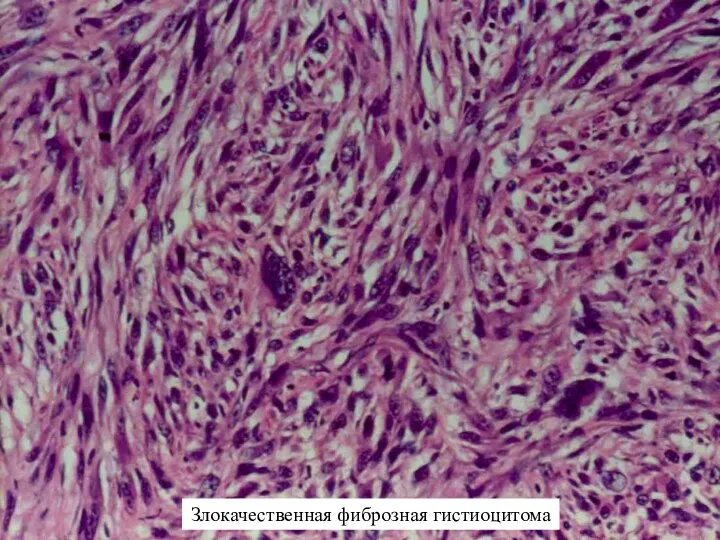 Злокачественная фиброзная гистиоцитома