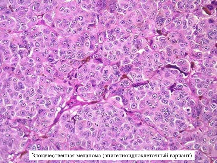 Злокачественная меланома (эпителиоидноклеточный вариант)