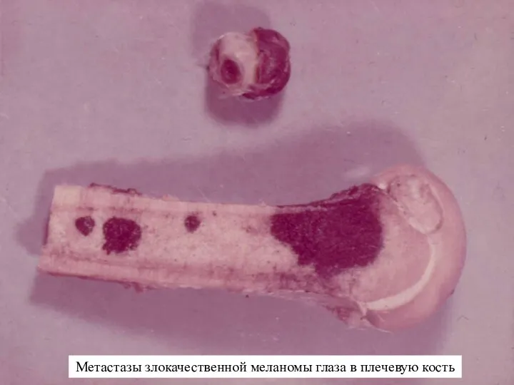 Метастазы злокачественной меланомы глаза в плечевую кость