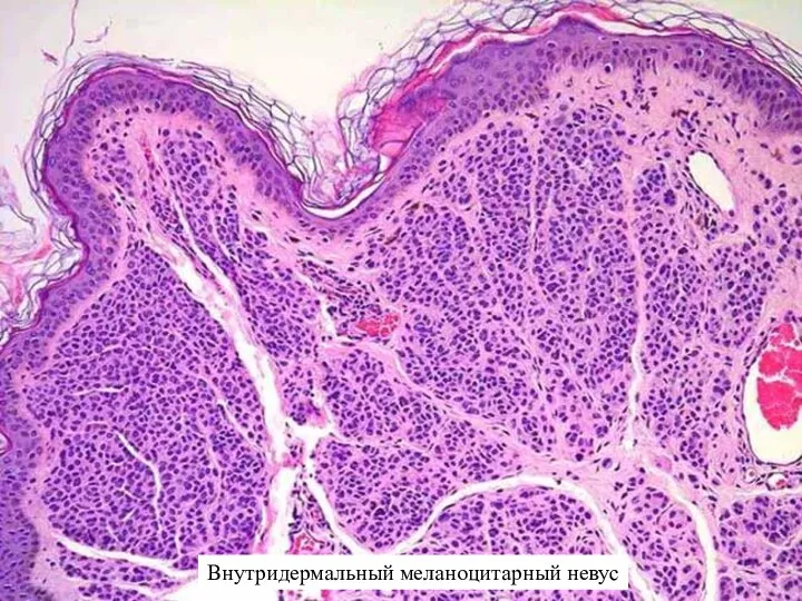 Внутридермальный меланоцитарный невус