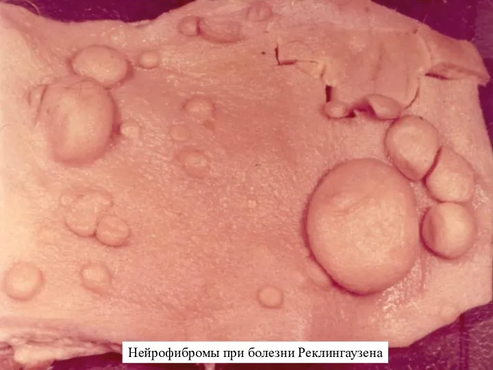 Нейрофибромы при болезни Реклингаузена