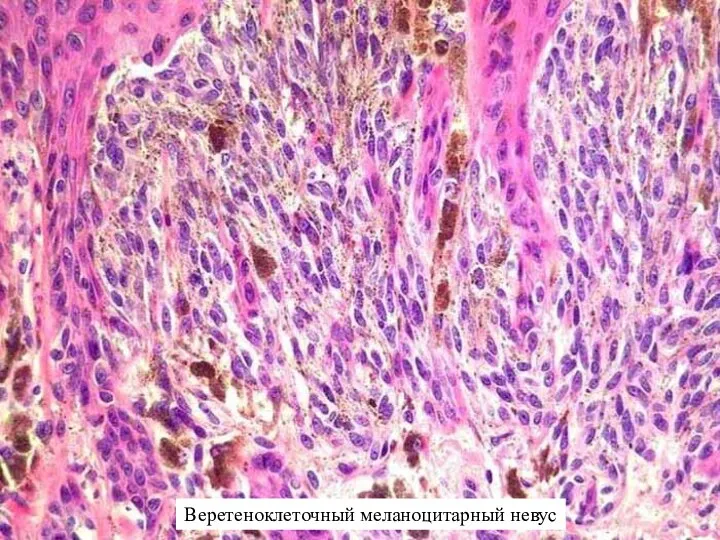Веретеноклеточный меланоцитарный невус
