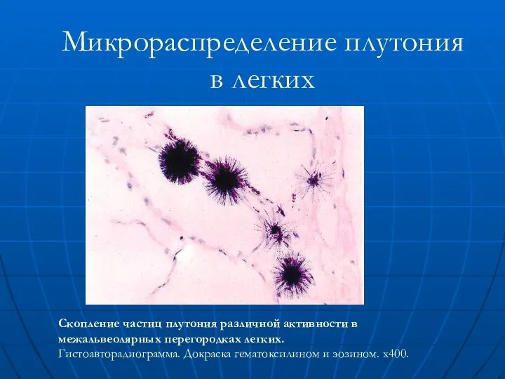 Микрораспределение плутония в легких Скопление частиц плутония различной активности в межальвеолярных