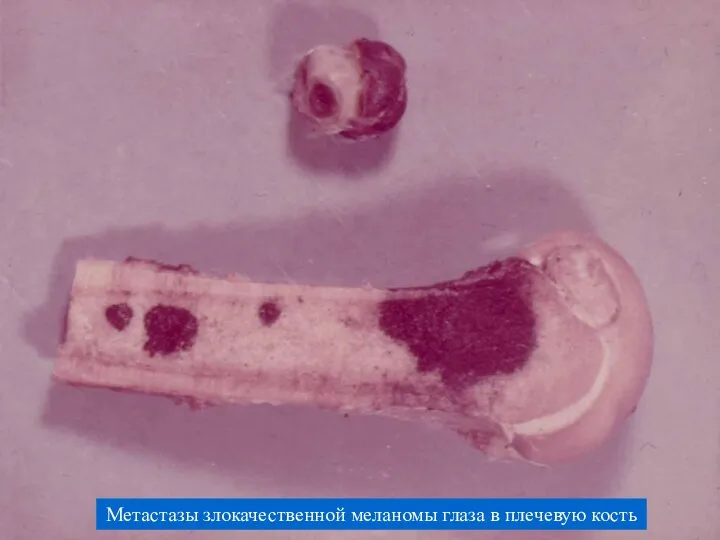 Метастазы злокачественной меланомы глаза в плечевую кость