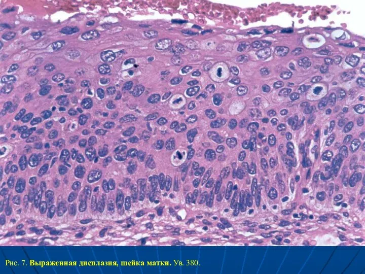 Рис. 7. Выраженная дисплазия, шейка матки. Ув. 380.